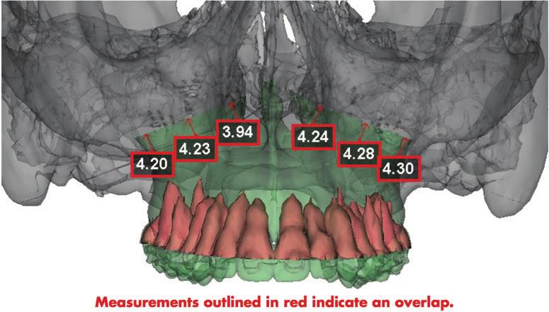 millimeter and when combined with 3D printed splints and customized prebent plates, the reconstructive and aesthetic outcome is superior to traditional 2-dimensional (2D) modeling and cephalometric