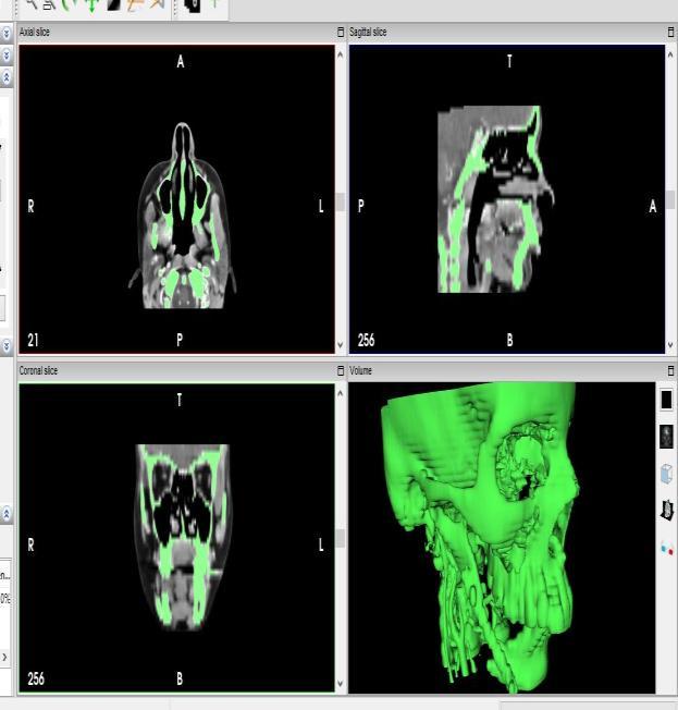 These DICOM files were opened in third party software called Invesalius 3.0(developed by Renato Archer Information Technology Center).