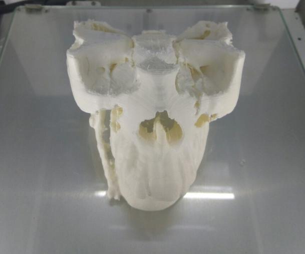 Figure 3: Printed anatomical model using PLA SECOND STAGE FABRICATION: Figure 2: Virtual 3D image generated This saved file was converted to STL (stereolithography) format which is the machine