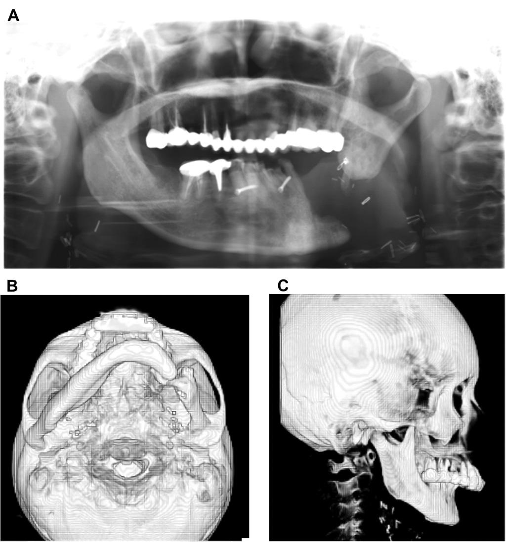 302 T.-M. Wang et al mandibular segments before the resection.