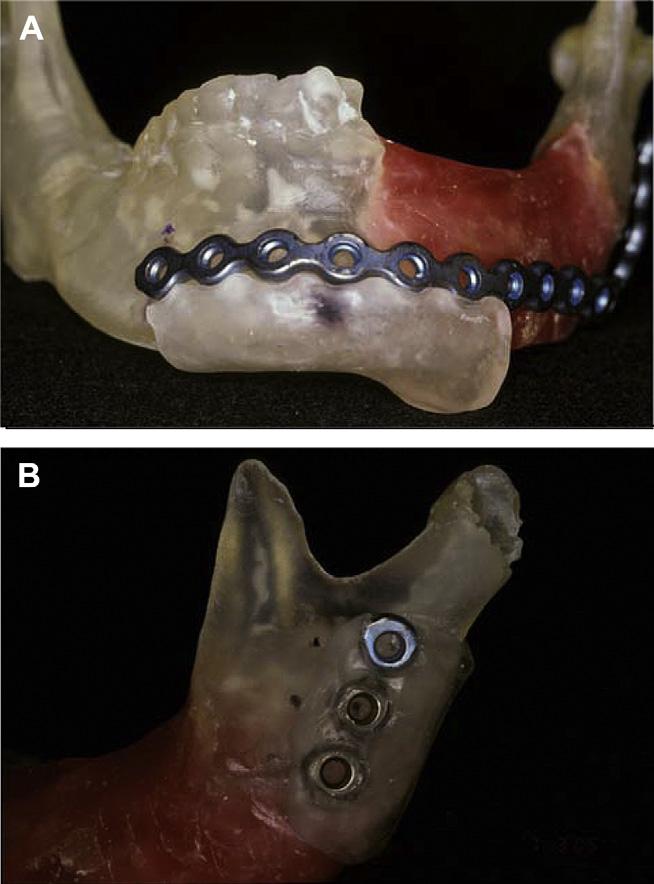 harmonized occlusion of the remaining teeth. Paraffin wax was used to fill in the gap between the two segments to achieve an ideal contour of the mandible (Fig. 2B).
