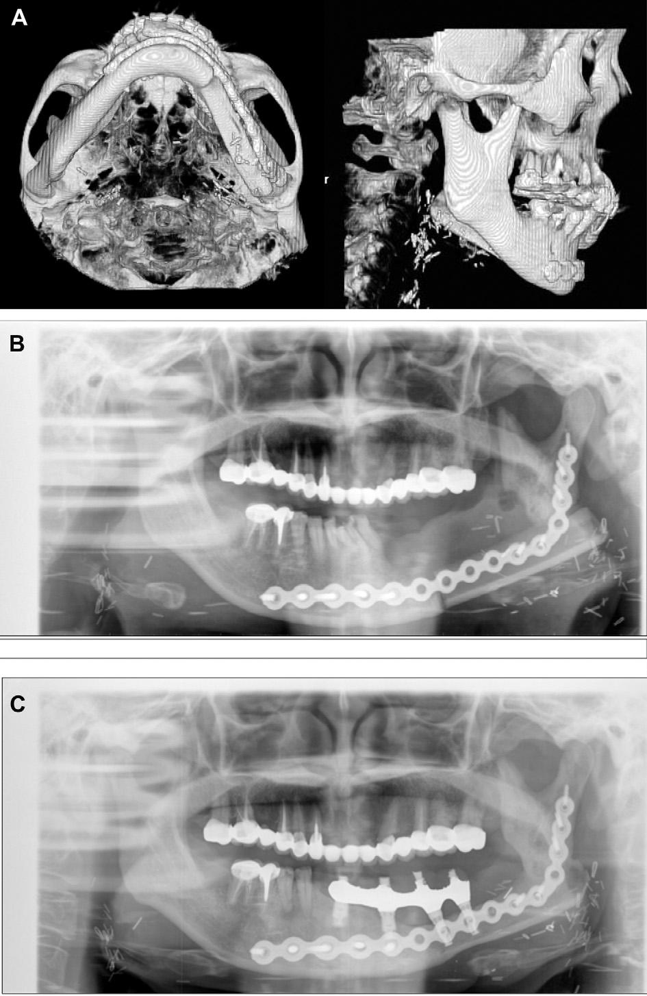 304 T.-M. Wang et al those on the STL model, the pre-adapted plate could be fixed on the mandibular segments and the mandibular continuity reestablished as planned.