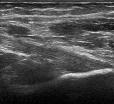 tuberosity (star). Typical fibrillar tendon pattern is absent.