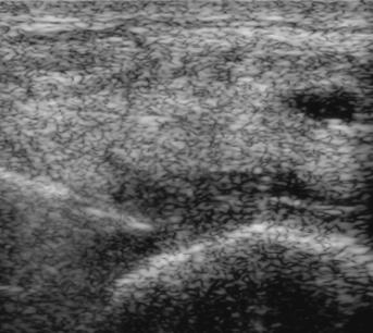 effusion with US guided aspiration (arrows).