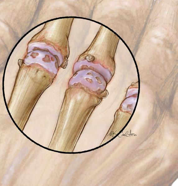 How do I know if I have osteoarthritis? Symptoms of Osteoarthritis When a joint is affected by osteoarthritis, there are 3 telltale signs you should recognize.