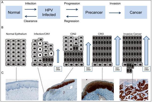 Cervical cancer progression model o Transitions are not well understood o Histologic categories do not