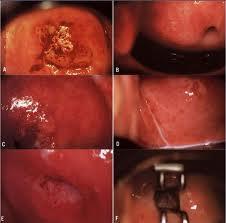 Screening for cervical cancer Combined Pap smear with Colposcopy Wang SS, Walker JL, Schiffman M, Solomon D.