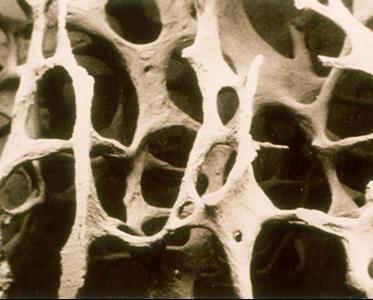 DEFINITION OF OSTEOPOROSIS characterized by low bone mass with micro