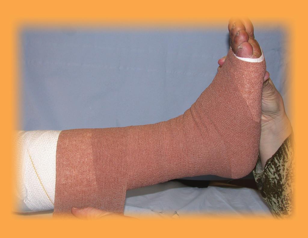 the wadding irritates the skin. 3. The sub-bandage wadding is applied in a spiral fashion, toe to knee, for protection of bony prominences and exudate absorption (Figure 4).