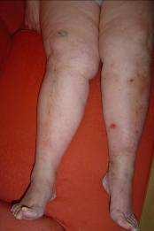 Chronic Venous Disease Why does venous disease result in Chronic