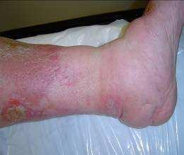 DVT and severe Chronic Venous Insufficiency cause damage to the