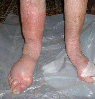 Causes of chronic oedema Increased venous capillary
