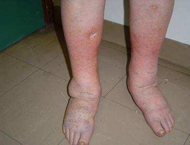 Background 10 Patients with Chronic Oedema