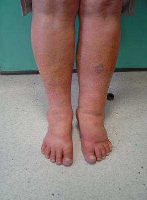 Case study 2 66 year old female with bilateral lymphovenous swelling of the