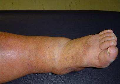 Case study 2 Tissue is soft with pitting oedema Positive Stemmer s sign She