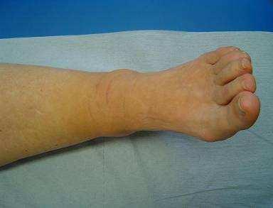 Case study 3 59 year old female Gradual onset of swelling of ankles and feet aged 56 The tissue is soft and pitting