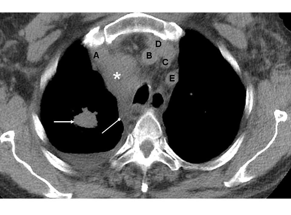 (asterisk) in the left paraesophageal region. Small lucencies within the mass suggest necrotic changes. Note anterior displacement of the trachea by the mass. Figure 5.