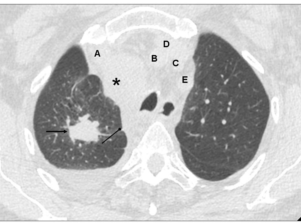 (arrow), enlarged right upper paratracheal (asterik) and retrotracheal (oval arrow) lymph nodes and right sided pleural effusion.