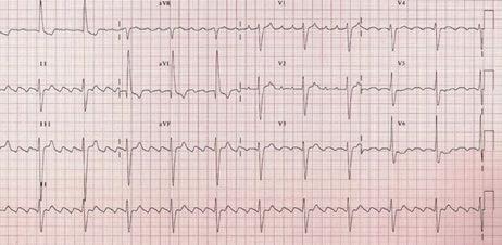 109 ECG Case 20 Please find the correct statements in following answer pages after ECG cases.