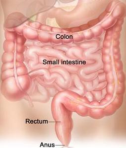 What is colorectal cancer? Also known as colon cancer it is a type of cancer that occurs in the colon or rectum. Facts About Colorectal Cancer What are the symptoms of colorectal cancer?