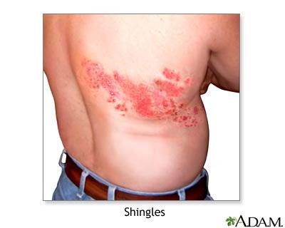 POST-HERPETIC NEURALGIA PAIN THAT PERSISTS AFTER SHINGLES INFECTION UNILATERAL, DERMATOMAL INCREASE IN INCIDENCE WITH AGE 80% IN PATIENTS 80YO