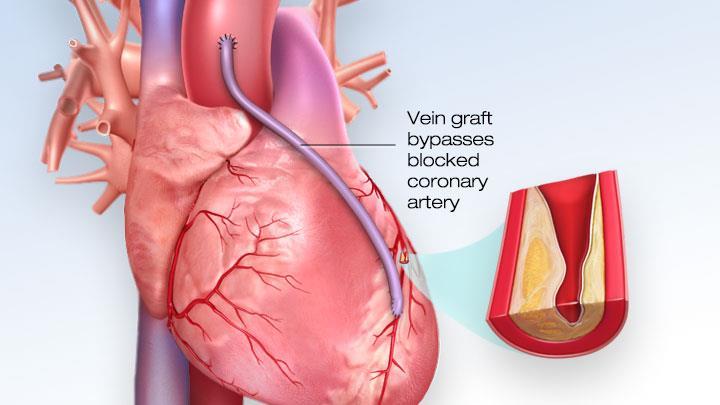 Treatments Coronary bypass removing a segment of healthy blood vessel from another part of the body and using it to create a new pathway