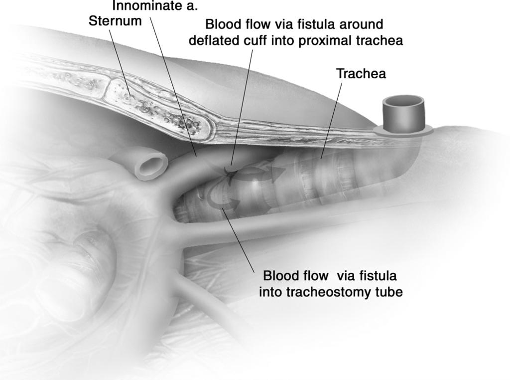 Managing tracheo-innominate artery fistula 67 Figure 1 Erosion of the tracheostomy tube or cuff through the trachea into the innominate artery, causing a tracheoinnominate fistula and bleeding into
