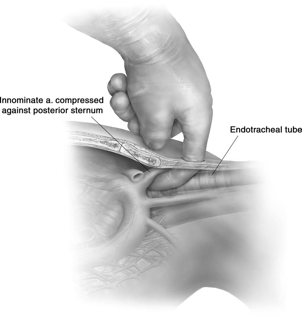 68 G. Ailawadi Figure 3 After extending the tracheostomy site widely, blunt finger dissection can create the pretracheal space.