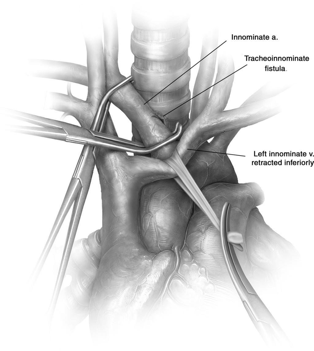 Managing tracheo-innominate artery fistula 69 Figure 4 Through a median sternotomy, the thymus is divided and upper part of the pericardium is opened to expose the distal ascending aorta.