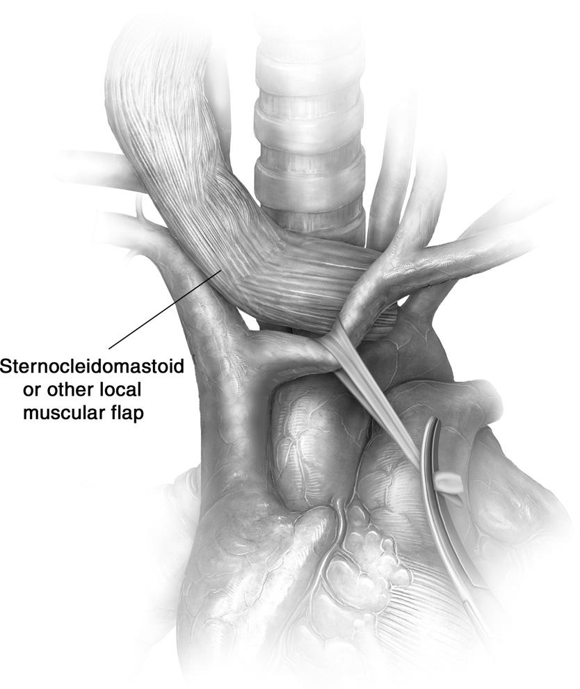 Managing tracheo-innominate artery fistula 71 Figure 6 A sternocleidomastoid muscle (or strap muscle) flap is used to