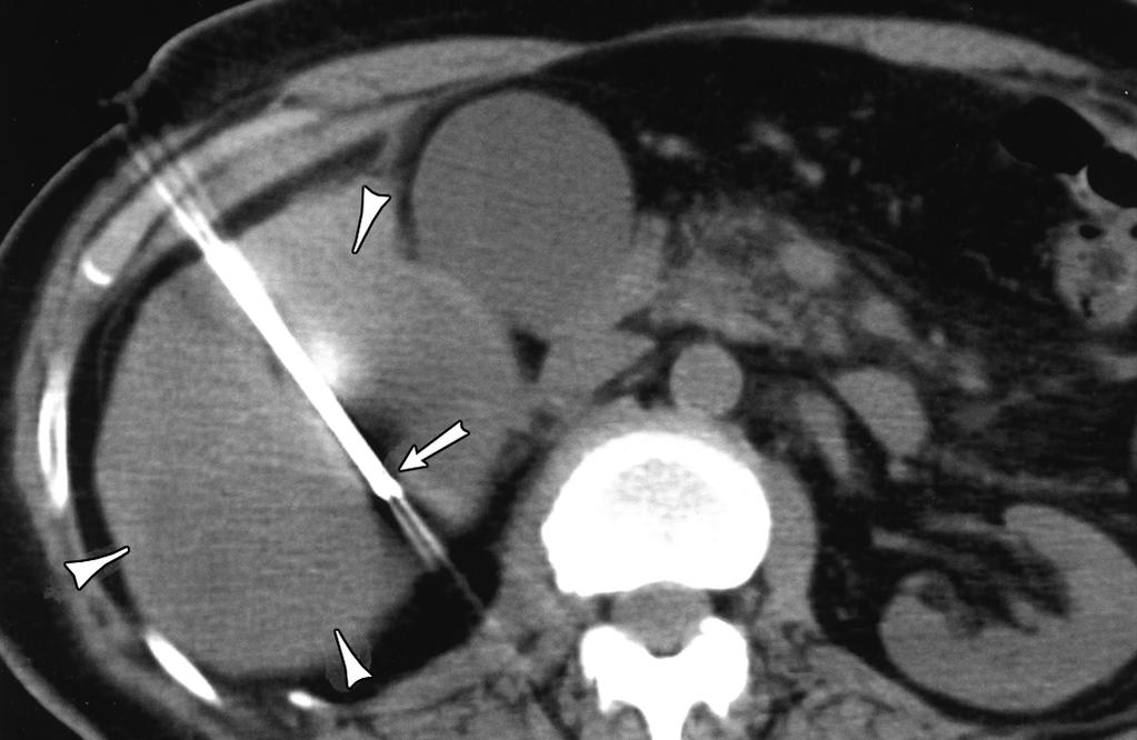 B, CT scan obtained during radiofrequency ablation procedure shows cluster electrode (arrow) with its tip in insulinoma (arrowheads).