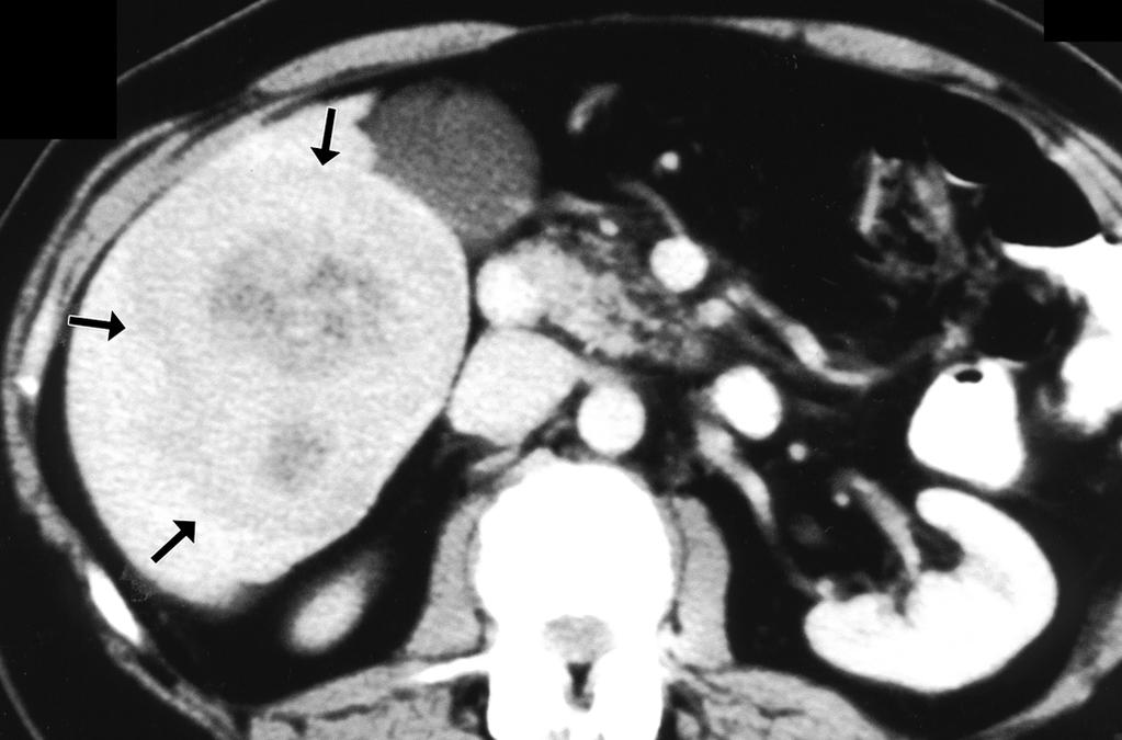 Note small volume of persistent bright enhancement (arrows) at periphery that was believed to be untreated and viable tumor.