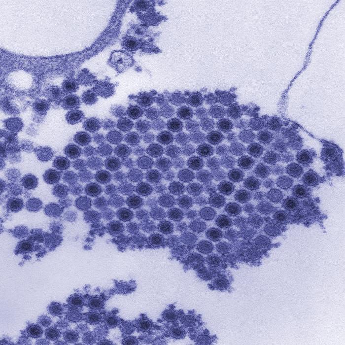 Transmission electron micrograph of chikungunya virus particles, CDC I: CHIKUNGUNYA Chikungunya fever is a mosquito-borne disease caused by a virus in the Alphavirus genus, Togaviridae family 1-4.