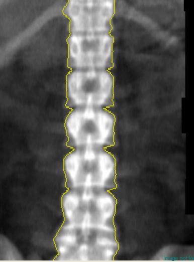 Anatomical variations of lumbar Spine Number of vertebrae Approximately 7% of