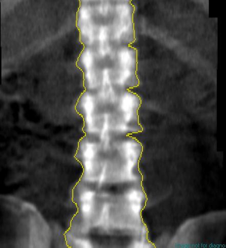 Anatomical variations of lumbar vertebrae 7.
