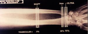 Anatomy of the Forearm Ulna Ulna styloid Radius 33% Shaft 5 mm