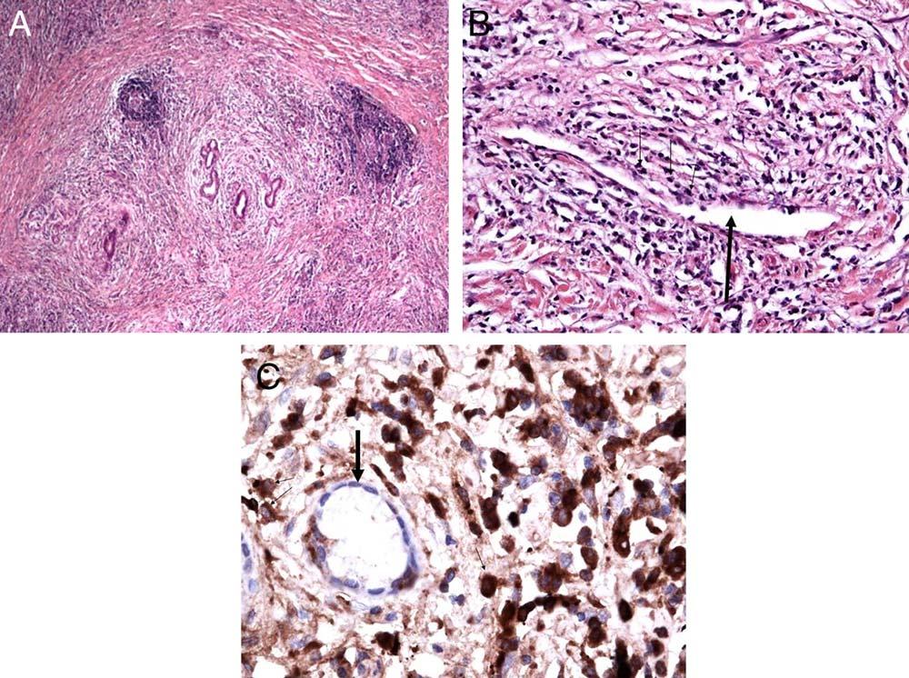 FIG 2 Histological features in IgG4-SC. Bile duct resection in IgG4-SC. (A) Lymphoplasmacytic infiltrate with periductal distribution and a storiform pattern of fibrosis (original magnification 310).