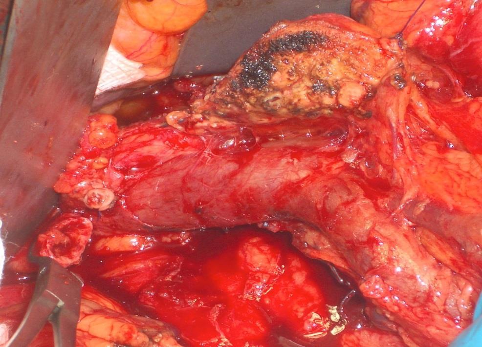 dcca - Pancreato duodenectomy with reconstruction