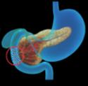 WHAT IS PANCREATIC EXOCRINE INSUFFICIENCY (PEI)?