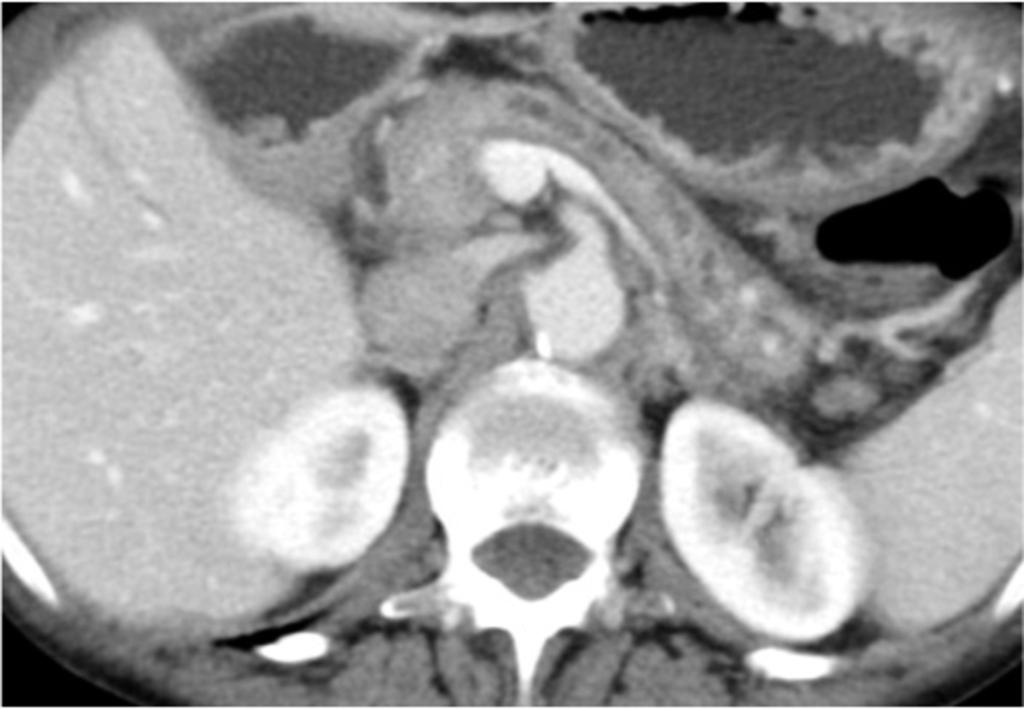 Fig. 3: Follow up imaging in the same patient after steroid treatment.