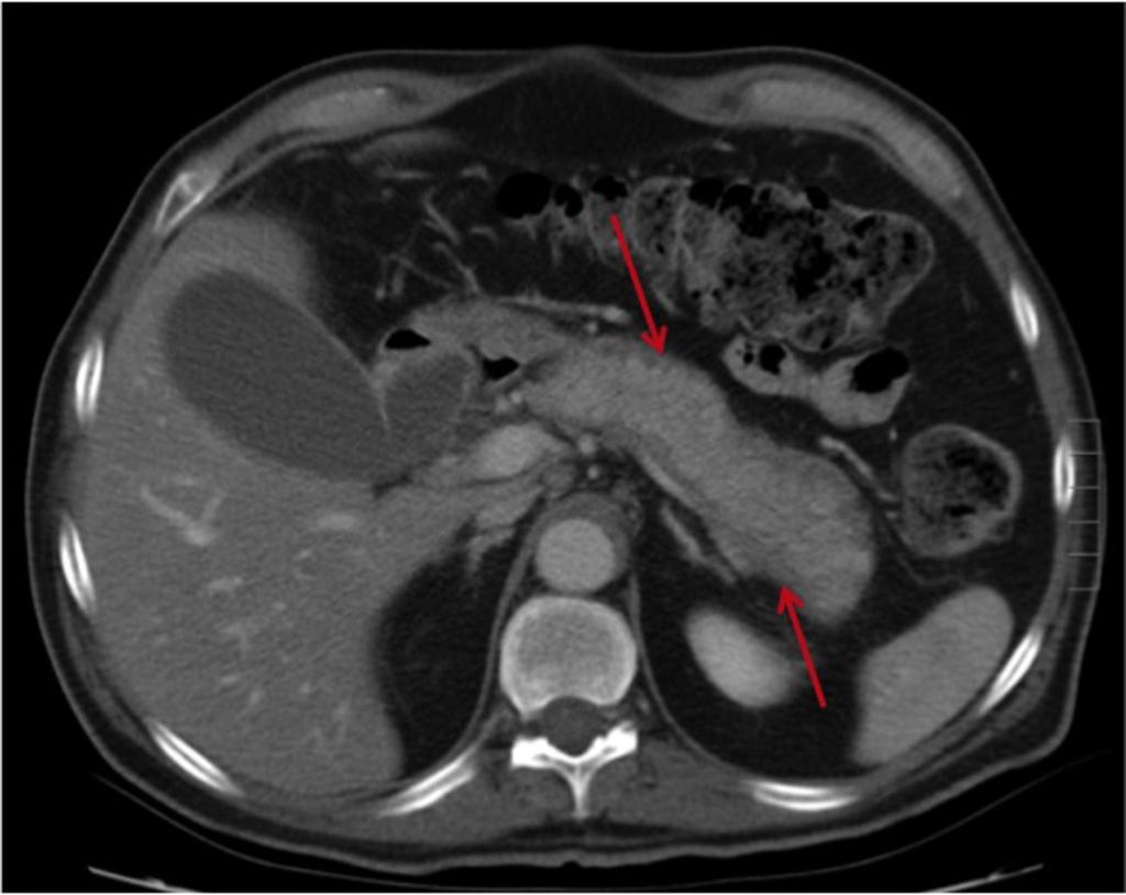 Fig. 4: Initial contrast-enhanced CT in a 65 year old male with AIP.