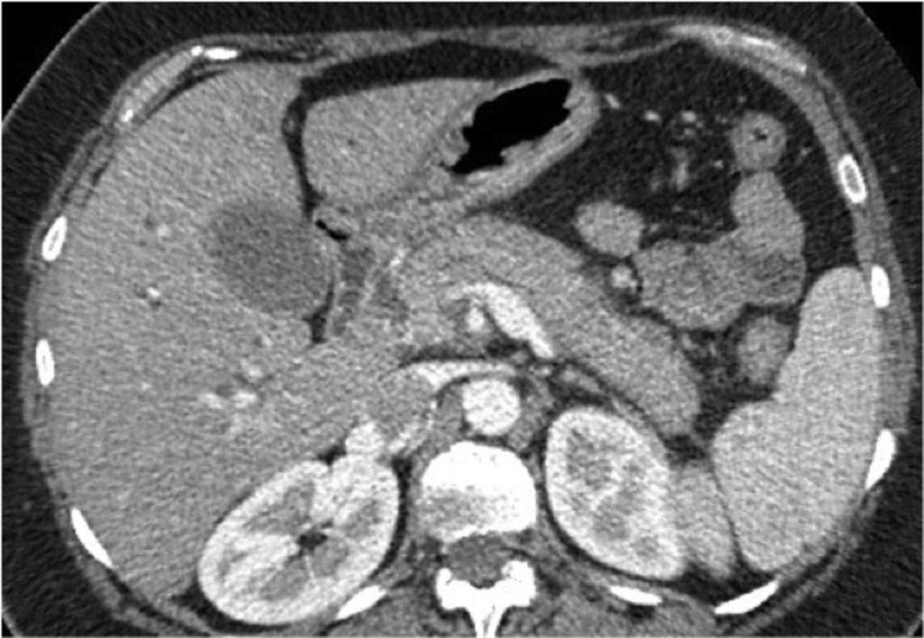 Fig. 6: Axial CECT in a 55 yo man presenting with epigastric pain and jaundice.
