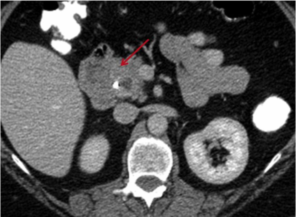 Fig. 9: CECT 55 yo male with focal hypodense mass in the pancreatic head (arrow), biliary stent in situ. Adenocarcinoma and focal AIP are often indistinguishable as illustrated.