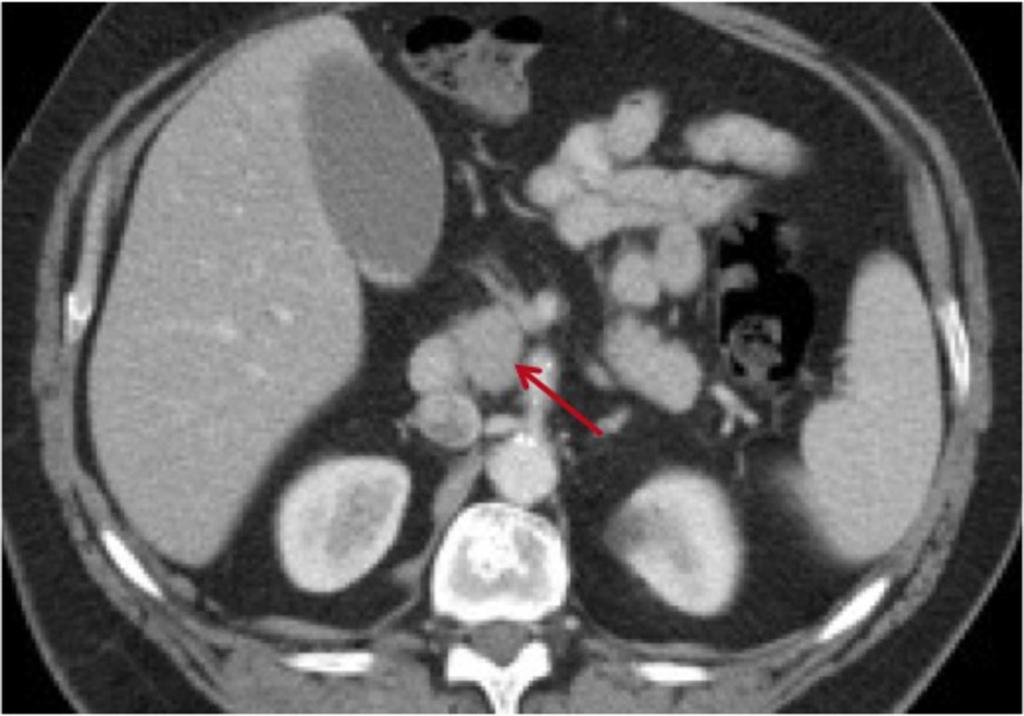 Fig. 11: Axial CECT 61 yo old male shows mildly