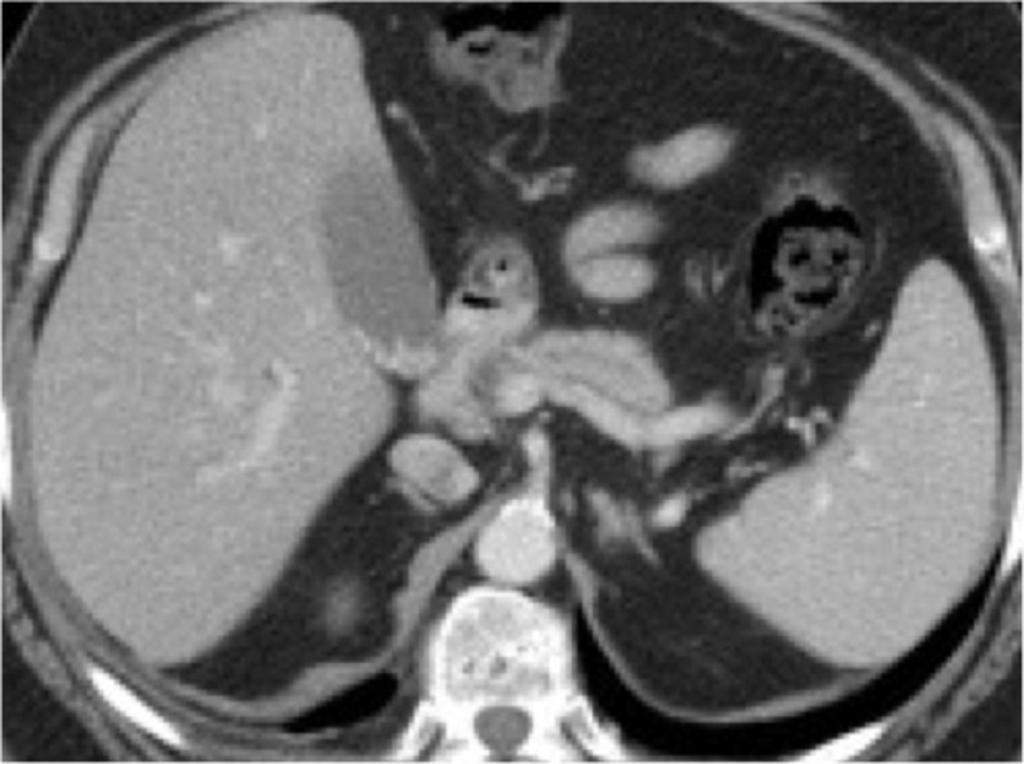 Fig. 13: Focal AIP in 61 yo axial CECT, note the mild upstream pancreatic duct dilatation.