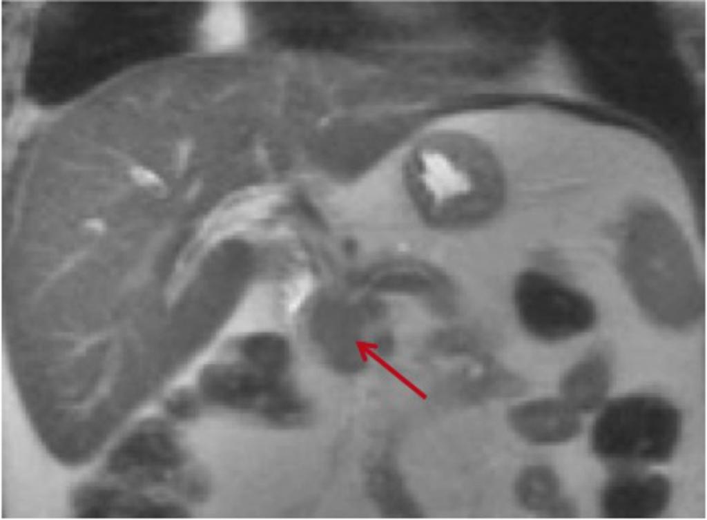 Fig. 14: MRCP coronal T2 from the same 61 yo patient demonstrated the focal mass in the pancreatic