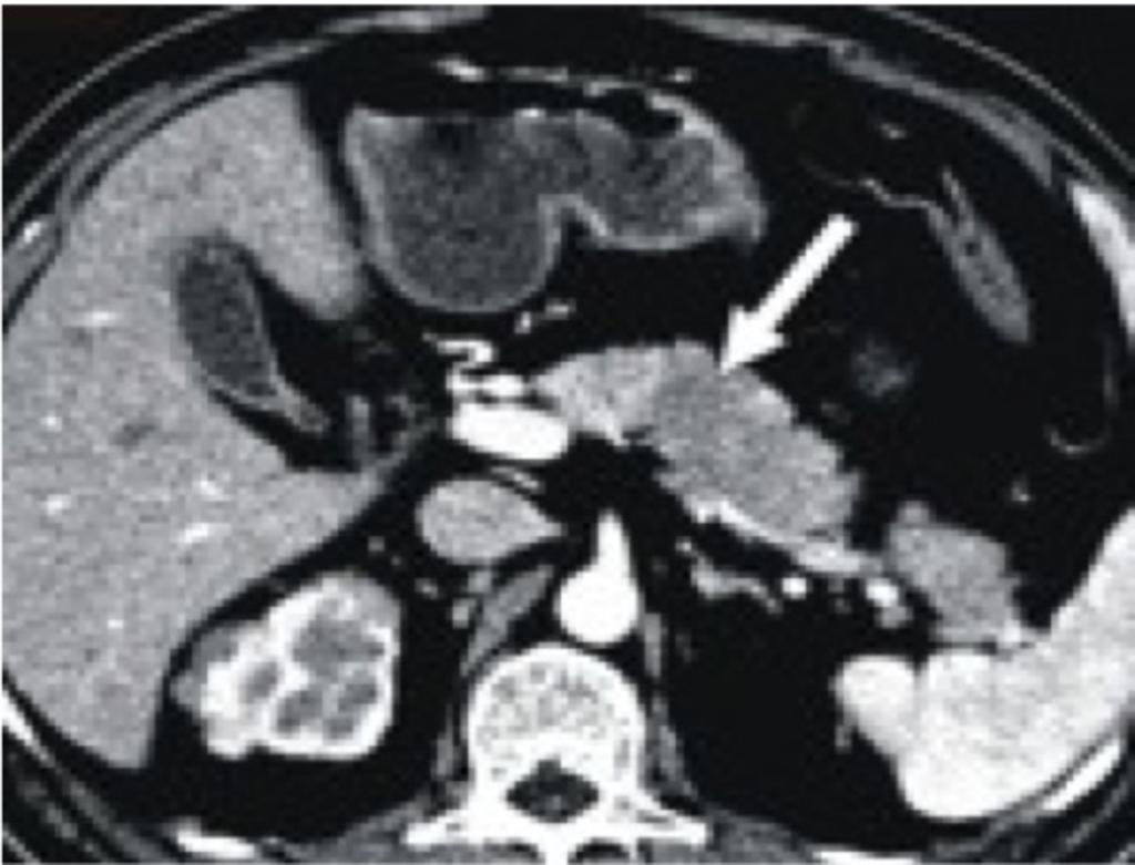 Fig. 16: Axial CECT showing focal hypoattenuating enlarged pancreatic body (arrow)
