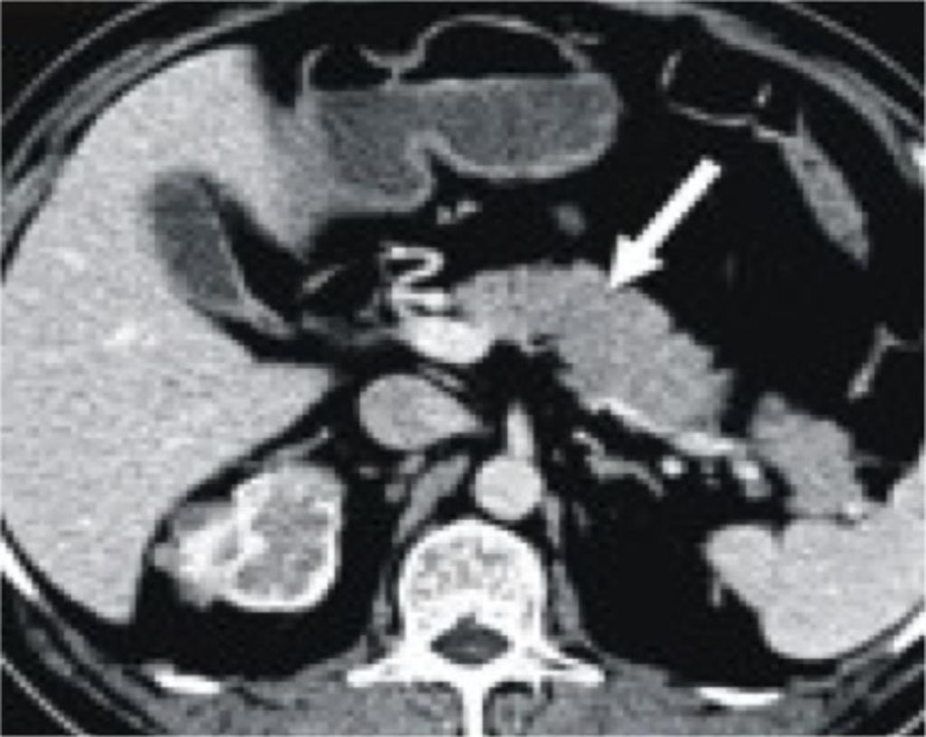 Fig. 17: Axial CECT showing normal homogenous pancreatic enhancement (arrow) and