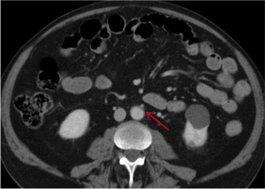 Fig. 19: Axial CECT post steroid treatment in 65 yo with AIP.