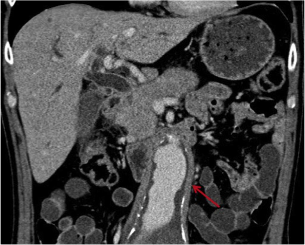 Fig. 20: Coronal CECT in a 55 yo man with AIP.
